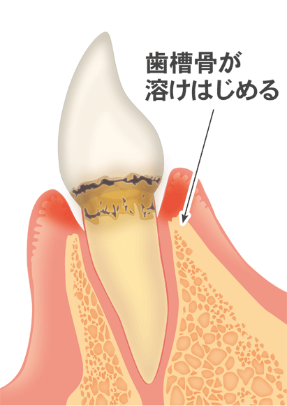 歯肉炎〜軽度歯周病